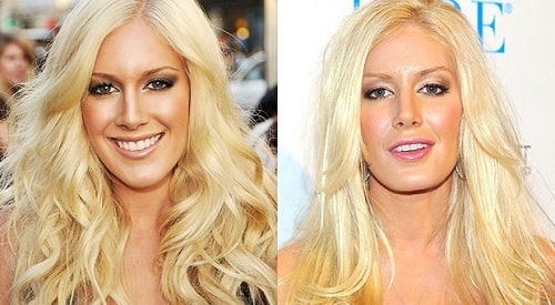 A picture of Heidi Montag before (left) and after (right).
